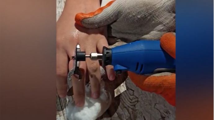 Qızın barmağında qalan üzüyü belə çıxardılar - VİDEO