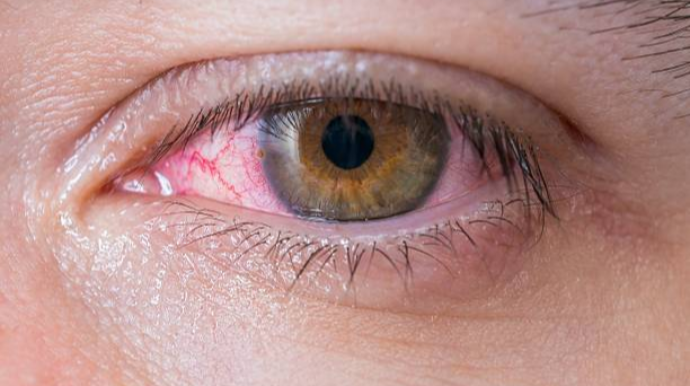 Koronavirus gözə necə təsir edir? 