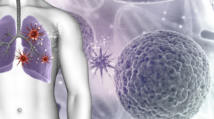 Süni intellekt ağciyər xərçəngini həkimlərdən dörd ay əvvəl aşkarlaya bilib 