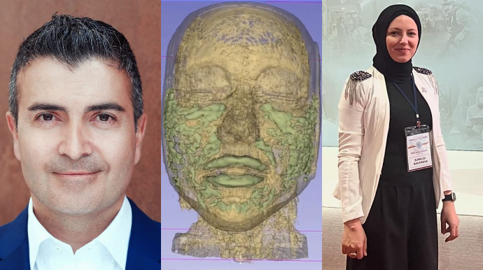 Üzünə botoks etdirmək istəyənlərin nəzərinə: görmə qabiliyyətinizi itirə bilərsiz – XƏBƏRDARLIQ  - VİDEO