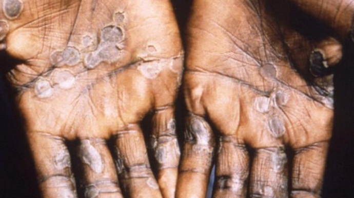 Çexiyada meymunçiçəyinə ilk yoluxma qeydə alınıb