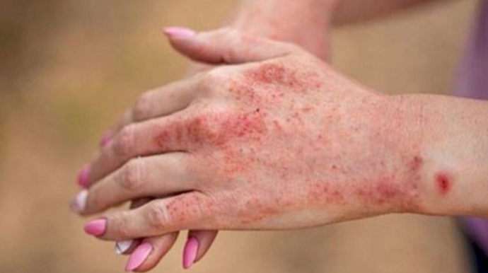 Azərbaycanda tələbə qızılcadan öldü