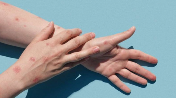 Meymunçiçəyi daha bir ölkəyə çatdı 