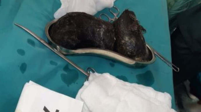 Bakıda 18 yaşlı qızın mədəsindən iki kiloqram “daş” ÇIXARILDI - FOTO