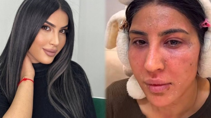 Reklam etdiyi pilinq Ləmanın üzünü yandırdı 