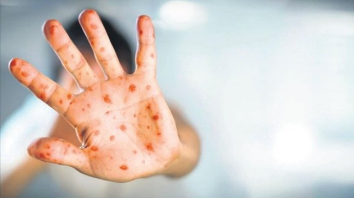 ÜST  meymunçiçəyi ilə bağlı fövqəladə vəziyyət elan etdi