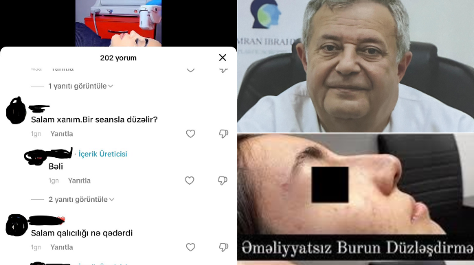 Azərbaycanda yeni fırıldaqçılıq:  “BURUN DÜZƏLDƏN” HƏKİM-KOSMETOLOQLAR ORTAYA ÇIXIB – VİDEO - FOTO  