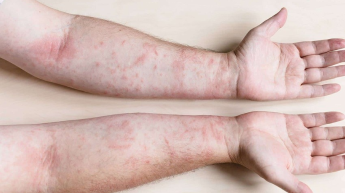 Son on gündə Cəlilabadda 83 nəfər qızılcaya yoluxub 