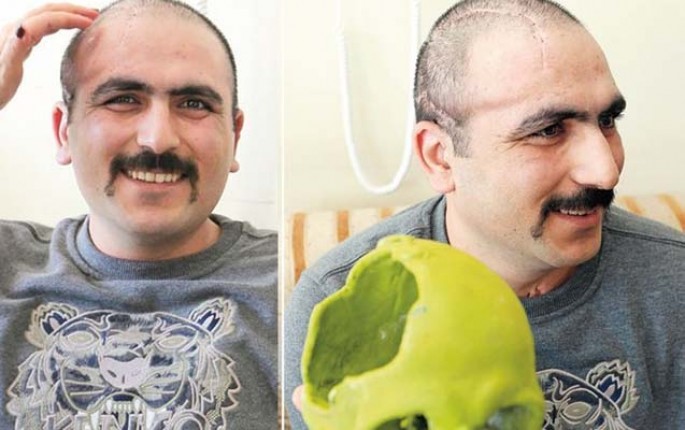 Aprel döyüşündə yaralanan hərbçiyə süni kəllə qapağı qoyuldu - FOTOLAR