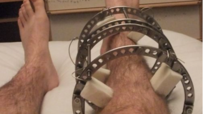 Müharibə şəraitində mühüm əhəmiyyətə malik xeyli sayda İlizarov aparatı ölkəyə gətirildi