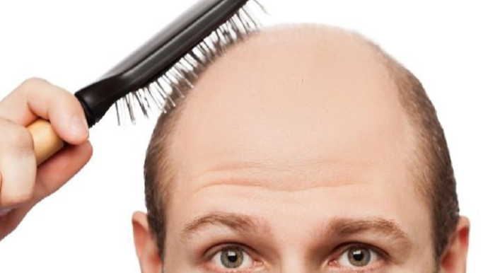 Niyə kişilərin saçı daha çox tökülür? – MARAQLI SƏBƏB 