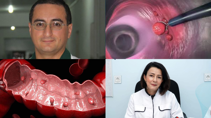 “Zərərsiz görünən təhlükə: Poliplər vaxtında müdaxilə olunmadıqda nə ilə nəticələnə bilər?” - AÇIQLAMA