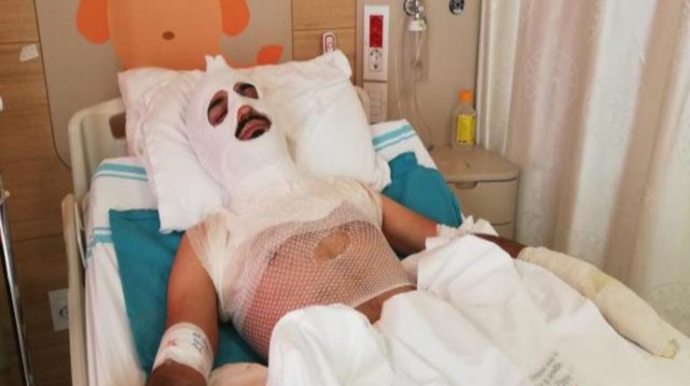 Tanınmış aktyor üzünü yandırdı  - FOTO