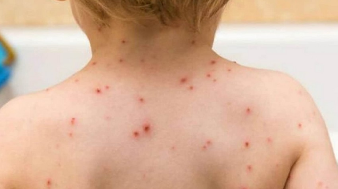 Niderlandda ilk dəfə uşaqda meymunçiçəyi aşkarlanıb