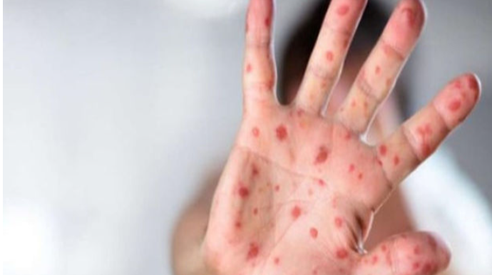 Zaqatalada qızılca xəstəliyi yayılıb