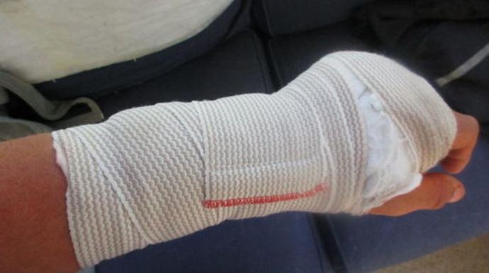 Bakıda yol qəzasında kişinin qolu sındı