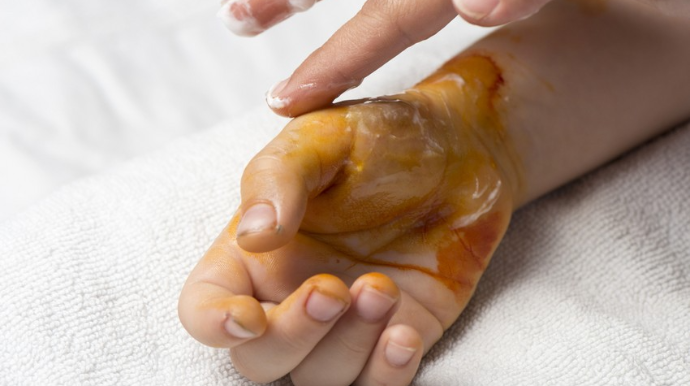 Sabirabadda 6 yaşlı uşaq yanıq xəsarətləri aldı