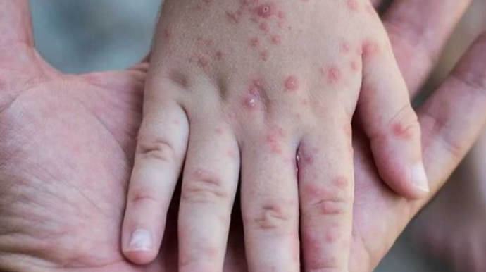 İki yaşlı uşağın qızılcadan ölməsi ilə bağlı TƏBİB-dən AÇIQLAMA