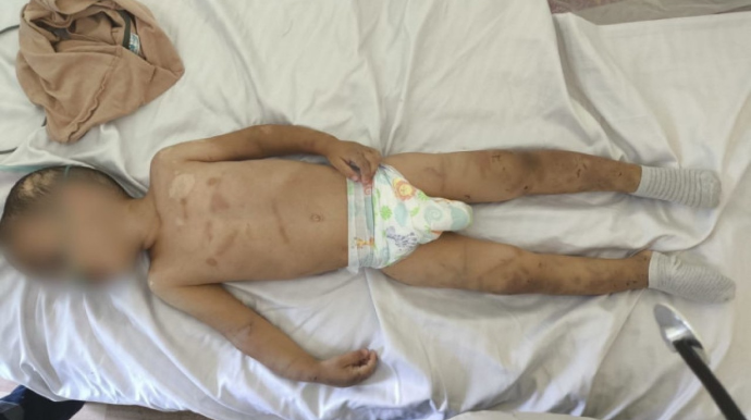 Valideynləri tərəfindən döyülən körpə süni nəfəs aparatına qoşuldu