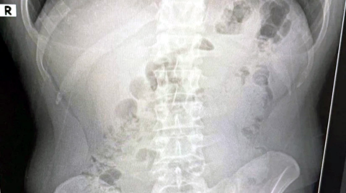 Mədələrində narktok maddə aşkarlanan İran vətəndaşları həbs edilib 