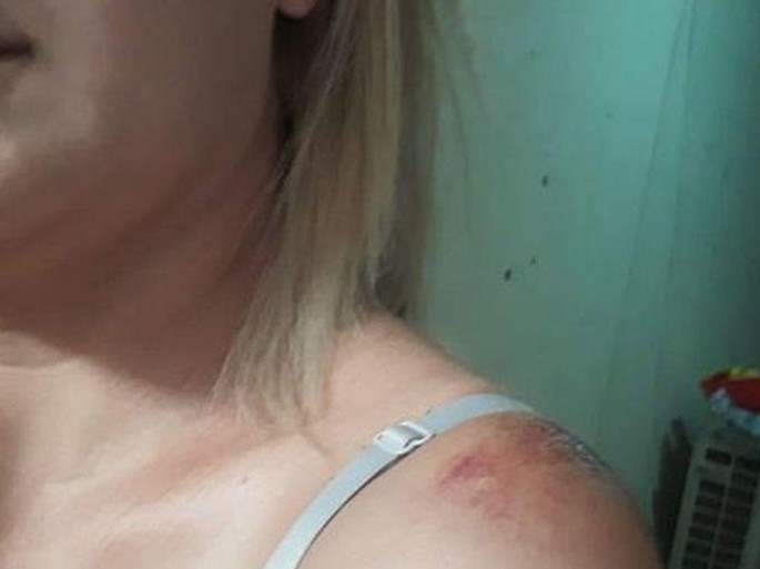 Sevgilisi tərəfindən vəhşicəsinə döyülən qızla bağlı YENİ XƏBƏR - FOTO