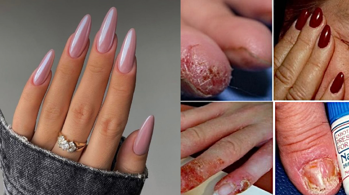 Estetik trend olan süni dırnaq xərçəng xəstəliyinə səbəb olur?- Adil Qeybulla AÇIQLADI 