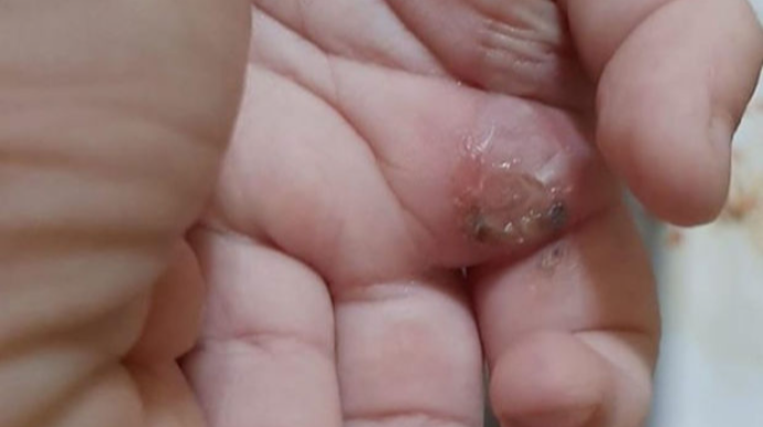 Bakıda DƏHŞƏT:  Narkoman valideynlər körpəyə işgəncə verdilər