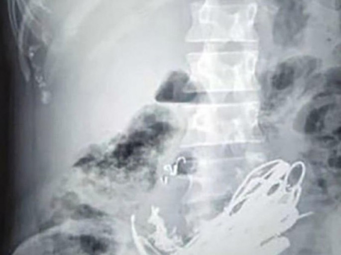 Qadının mədəsindən inanılmaz şeylər çıxdı