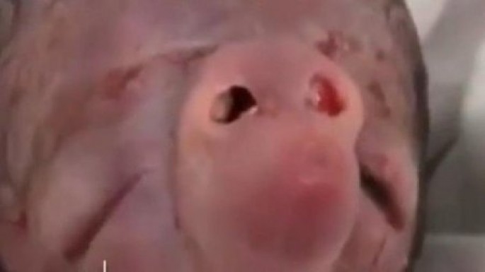 Bakıda ağzı olmayan uşaq dünyaya gəldi - VİDEO