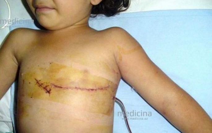 Bakıda 5 yaşlı qızın ürəyinə iynə batdı - Bir saat geciksəydi... - FOTO