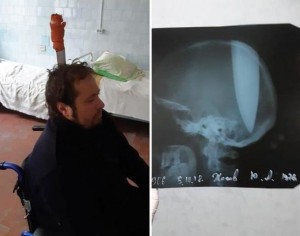 Başına bıçaq sancılan rusiyalı zökəmdən şikayətləndi - VİDEO (18+)