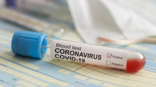 Azərbaycanda daha 38 nəfər koronavirusa yoluxub