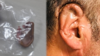 Qopan qulağı 34 saat sonra yerinə tikdi - FOTO