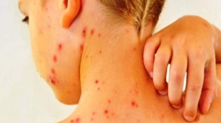 Azərbaycanda suçiçəyi xəstəliyinin artmasının  səbəbi AÇIQLANDI