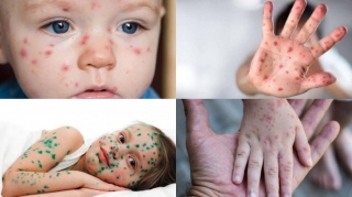 Uşaqlarda suçiçəyi sürətlə yayılır - Valideynlər nəyə diqqət etməlidir? - İnfeksionist AÇIQLADI 