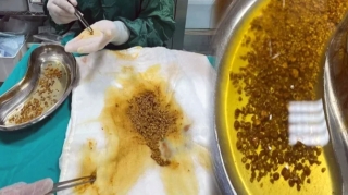 Tibb dünyasını təəccübləndirən əməliyyat - Öd kisəsindən 2067 daş çıxarıldı 