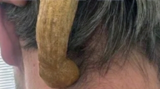 Həkimlər kişinin başındakı buynuzu əməliyyatla çıxardılar - FOTO 