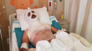 Tanınmış aktyor üzünü yandırdı  - FOTO