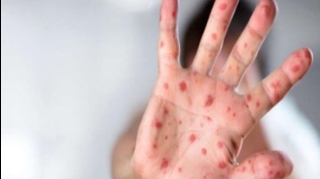 Zaqatalada qızılca xəstəliyi yayılıb