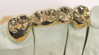 Bakıda qızıl diş oğrusu tutuldu  - VİDEO