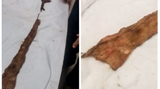 Şirvan sakininin qarnında 8 ay əvvəl əməliyyat zamanı unudulan tampon aşkar edilib  - FOTO - VİDEO
