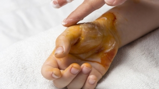 Sabirabadda 6 yaşlı uşaq yanıq xəsarətləri aldı