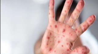 Azərbaycanda qızılcaya yoluxma ilə bağlı son vəziyyət açıqlandı