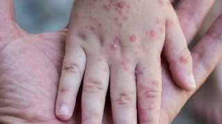 İki yaşlı uşağın qızılcadan ölməsi ilə bağlı TƏBİB-dən AÇIQLAMA 