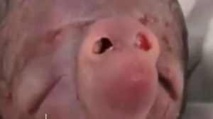 Bakıda ağzı olmayan uşaq dünyaya gəldi       - VİDEO