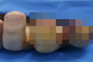 Pirotexniki vasitə turistin əlində partladı: iki barmağı kəsilib - VİDEO