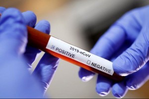 Azərbaycanda daha 104 nəfərdə koronavirus aşkarlandı