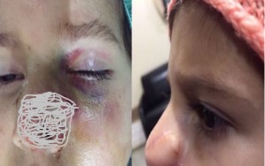 Azərbaycanda 4 yaşlı uşağın it qoparan burnu bərpa edildi - ŞOK ƏMƏLİYYAT - FOTOLAR